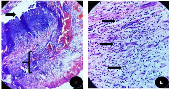 Apéndice cecal. (a) Imagen en 10x, la flecha negra muestra el lumen apendicular, y en corchetes la capa muscular con celularidad entre sus fibras musculares lisas. Asimismo, áreas de hemorragia y edema de su pared. (b).Imagen en 40x, las flechas negras muestran presencia de abundantes neutrófilos disecando las fibras musculares lisas.  