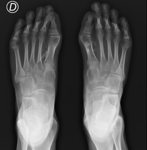 Deformidad en hallux valgus con ángulo articular metafisario distal aumentado del primer metatarsiano, con osificación heterotópica alrededor del primer rayo.