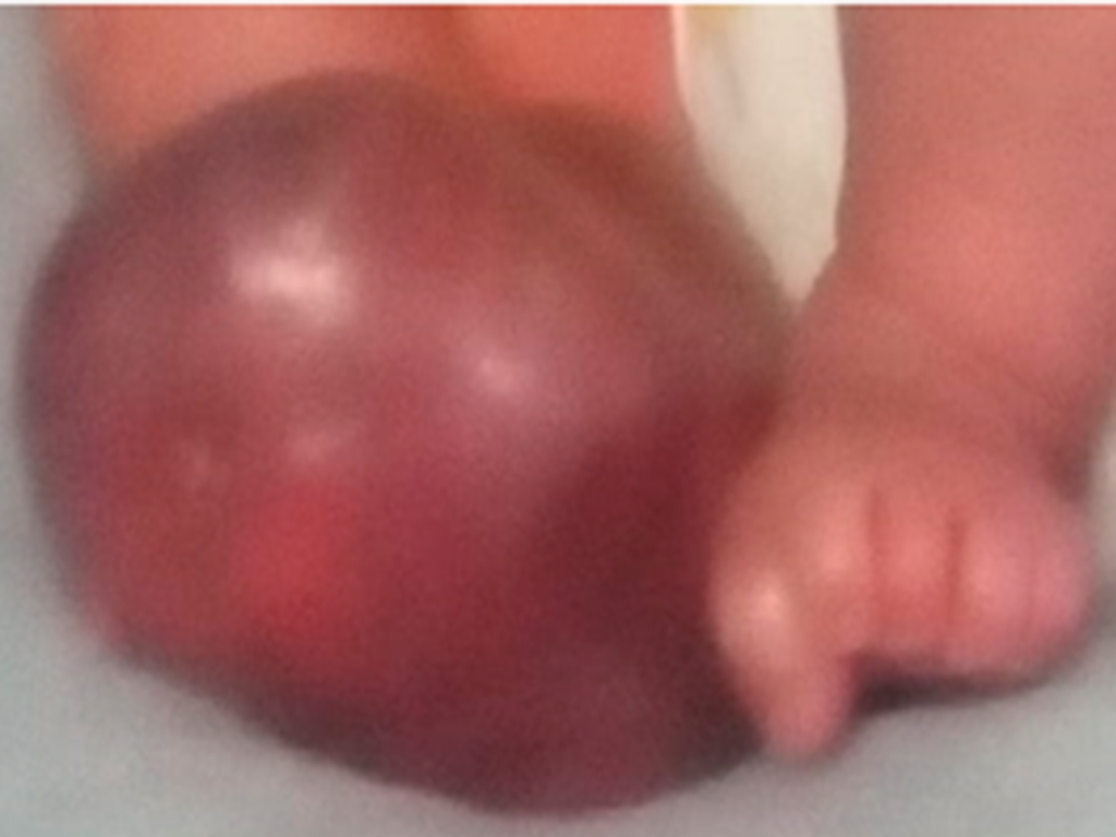 Edema y muñón equimótico de extremidad inferior derecha