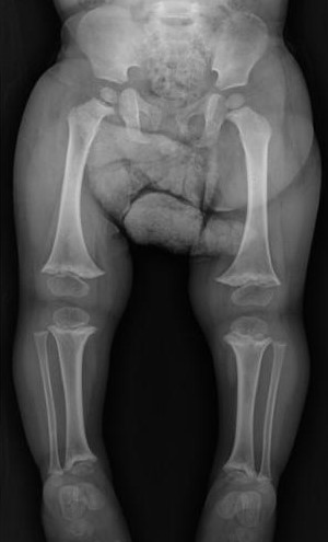 Ortroradiografia de miembros inferiores en bipedestación.  Acortamiento longitudinal de fémur, tibia y peroné bilateral, ensanchamiento metafisario con irregularidad del contorno proximal y distal, sin compromiso epifisario. Genu varo bilateral. 
